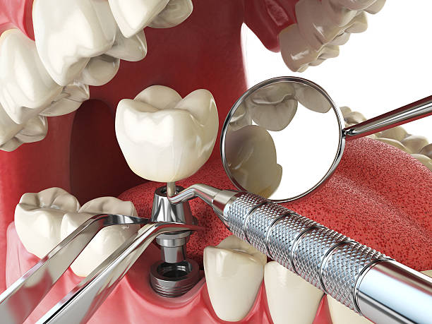 Best Emergency Dentist for Knocked-Out Tooth in Byesville, OH